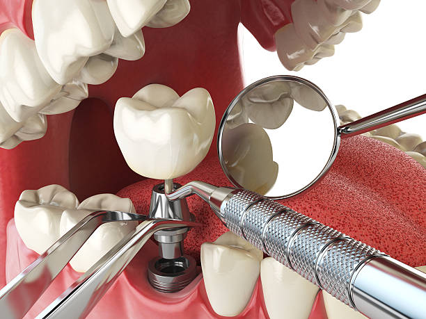 Best Emergency Wisdom Teeth Removal in Hurstbourne, KY